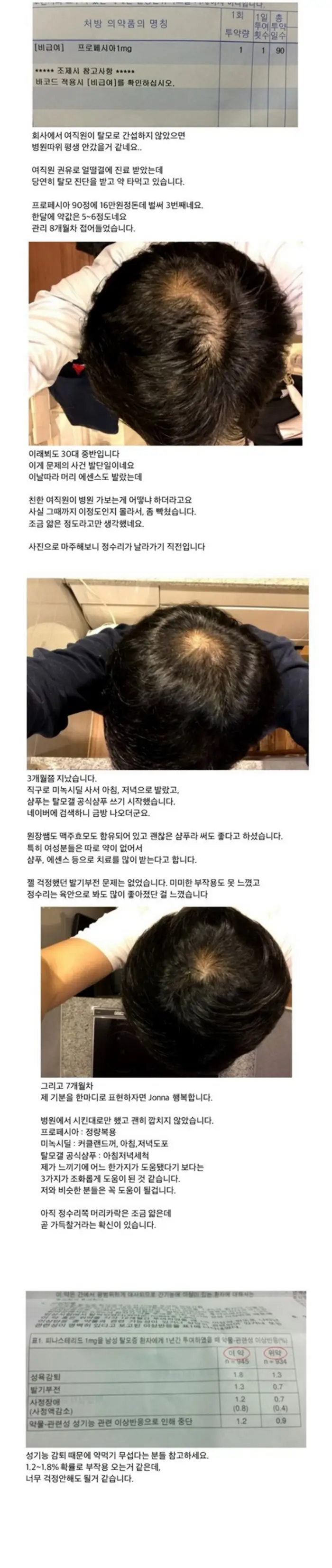 이게 가능한가 싶은 탈모 극복 후기ㄷㄷ