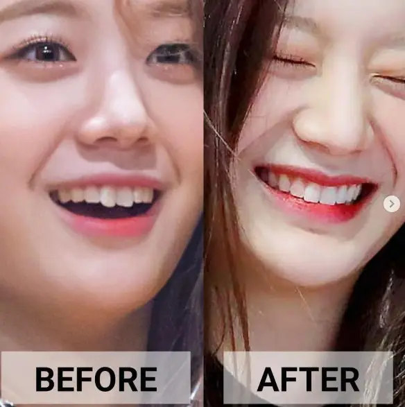 프로미스나인 장규리 치아교정 전후