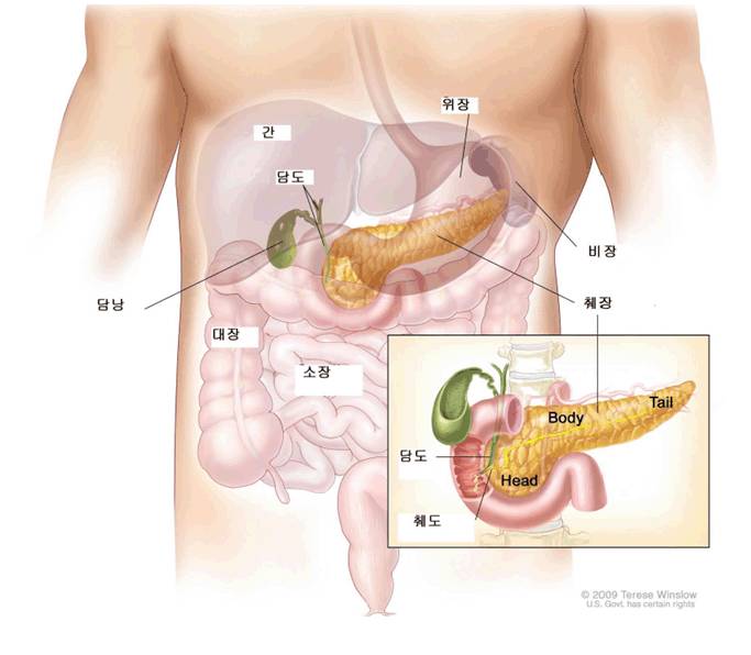 췌장암 발견이 어려운 이유